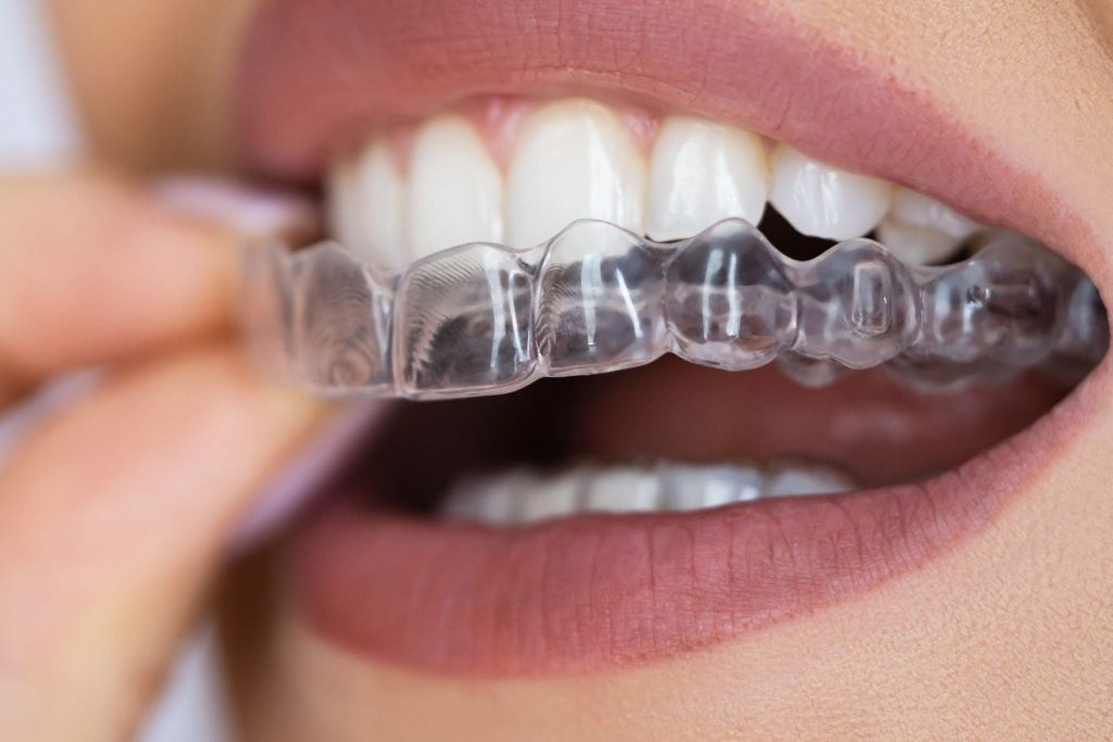 Gouttières transparentes pour adultes à Lille – Aligneurs transparents à Lille
