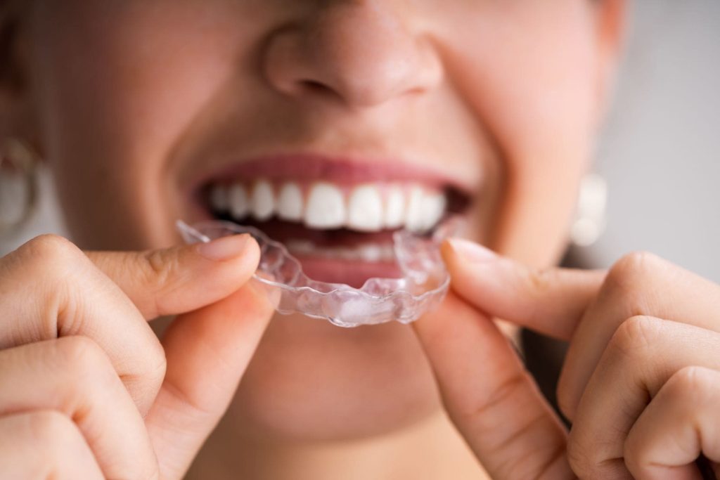 Adolescente posant une gouttière transparente, traitement d'orthodontie pour adolescent à Lille