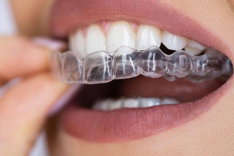 Gouttières transparentes pour adultes à Lille – Aligneurs transparents à Lille