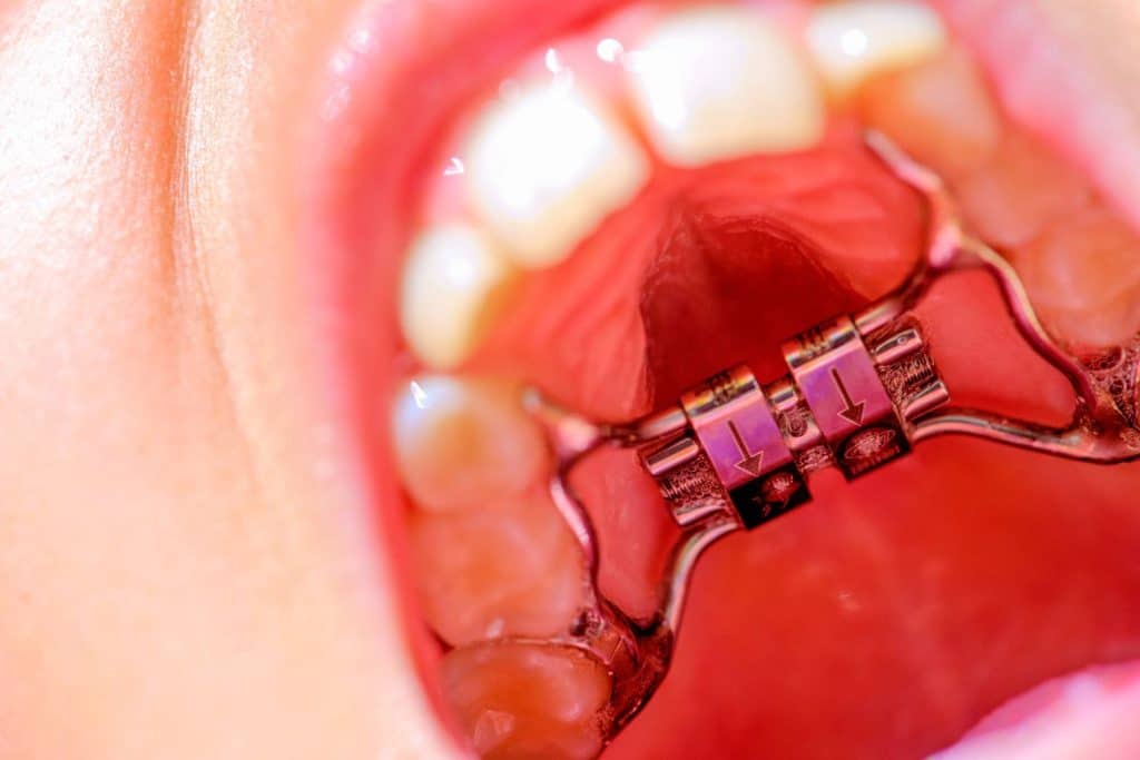 Appareil d'expansion palatine posé au palais d'un enfant, orthodontie pour enfant à Lille