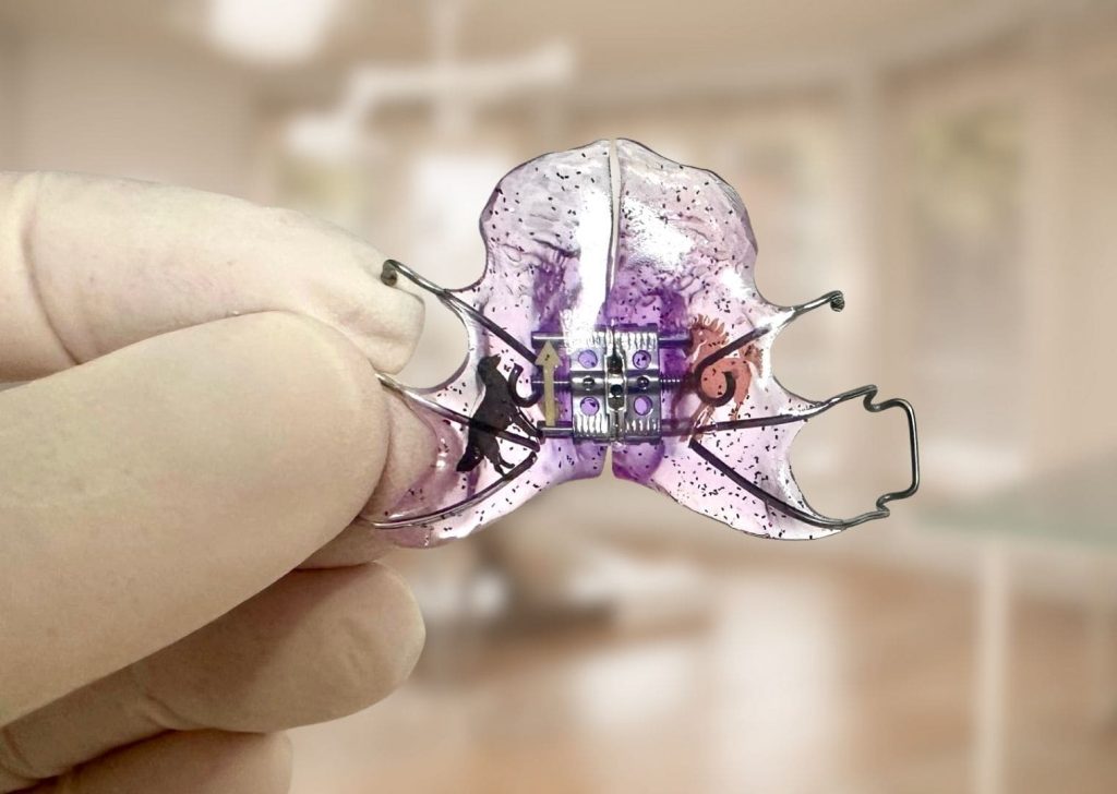 Appareil amovible d'orthodontie interceptive pour enfant, cabinet du Dr Skarbek Borowski à Lille