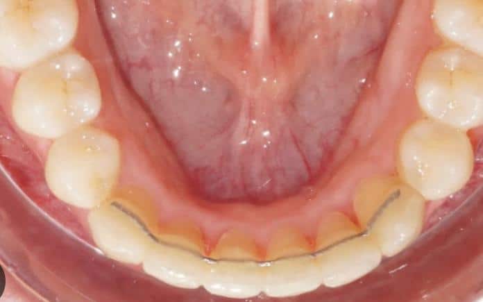 Attelle de contention collée derrière les dents du bas après un traitement d'orthodontie à Lille