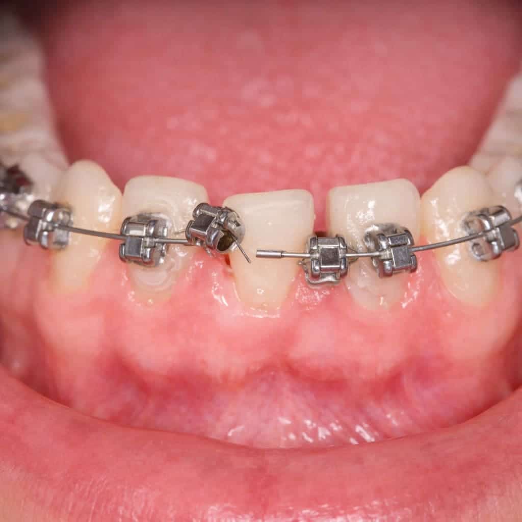 Que faire en cas d’urgence orthodontique : si j'ai décollé un boîtier ?